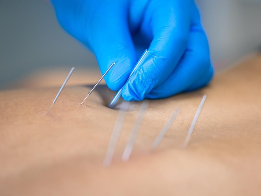 The Premier Acupuncture In Thornhill Service